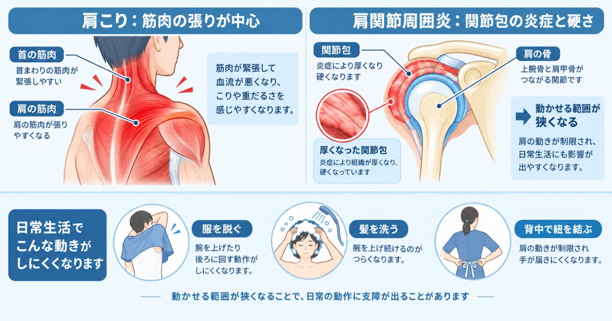 その痛みは肩こりとは違う？四十肩・五十肩の症状の特徴